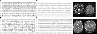 Refractory Status Epilepticus in Genetic Epilepsy—Is Vagus Nerve Stimulation an Option?